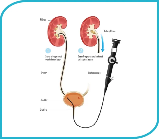 Laser RIRS for Stones (Retrograde Intrarenal Surgery)-