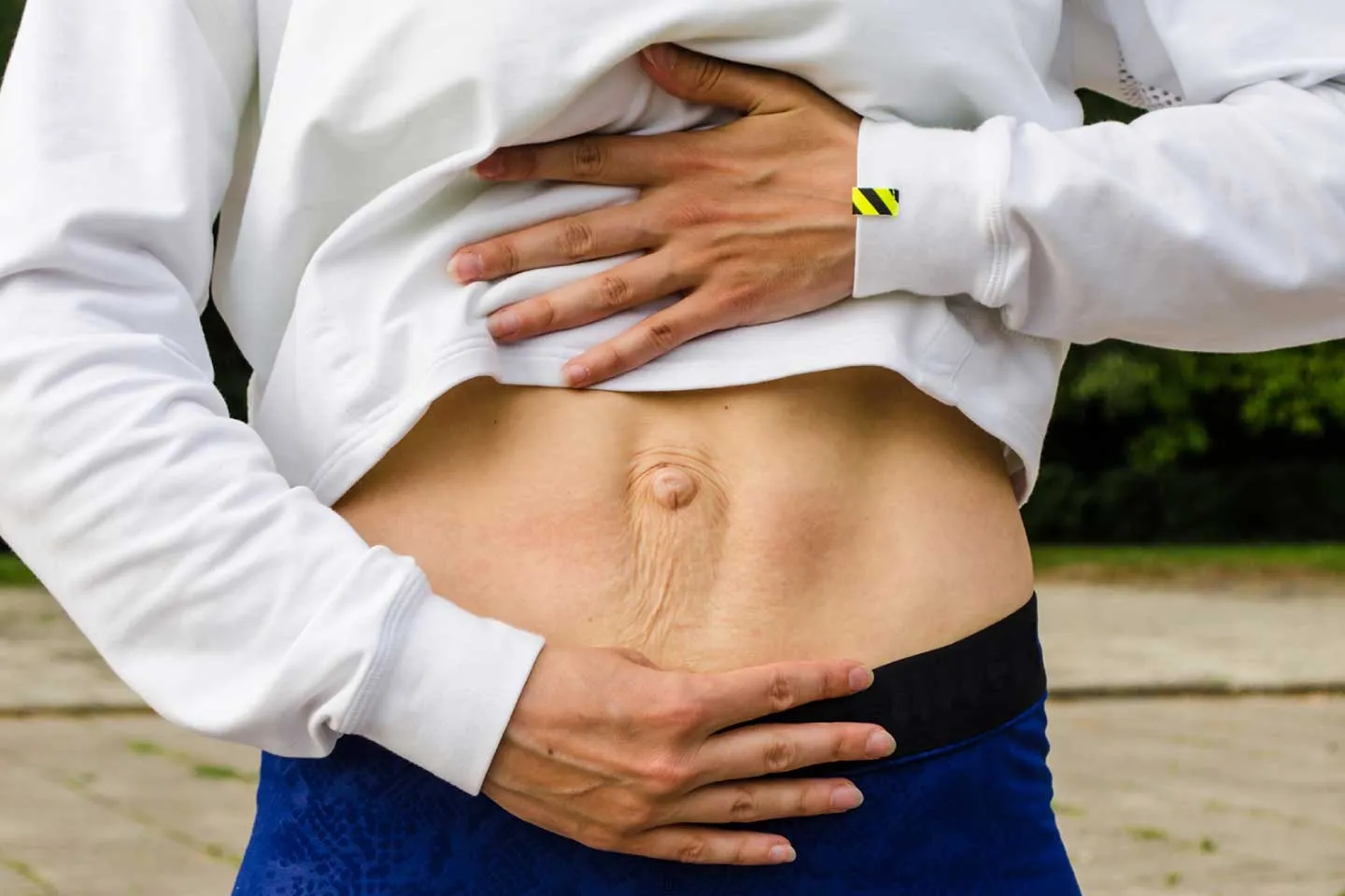 What Is Diastasis Recti (Abdominal Separation)?