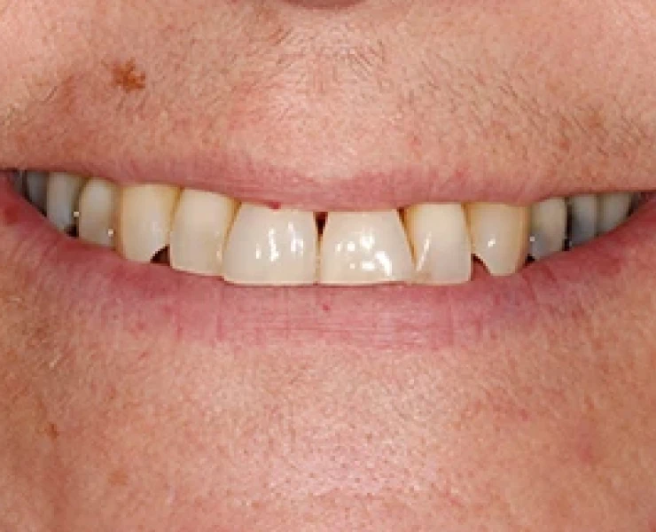Enlighten Teeth Whitening 3