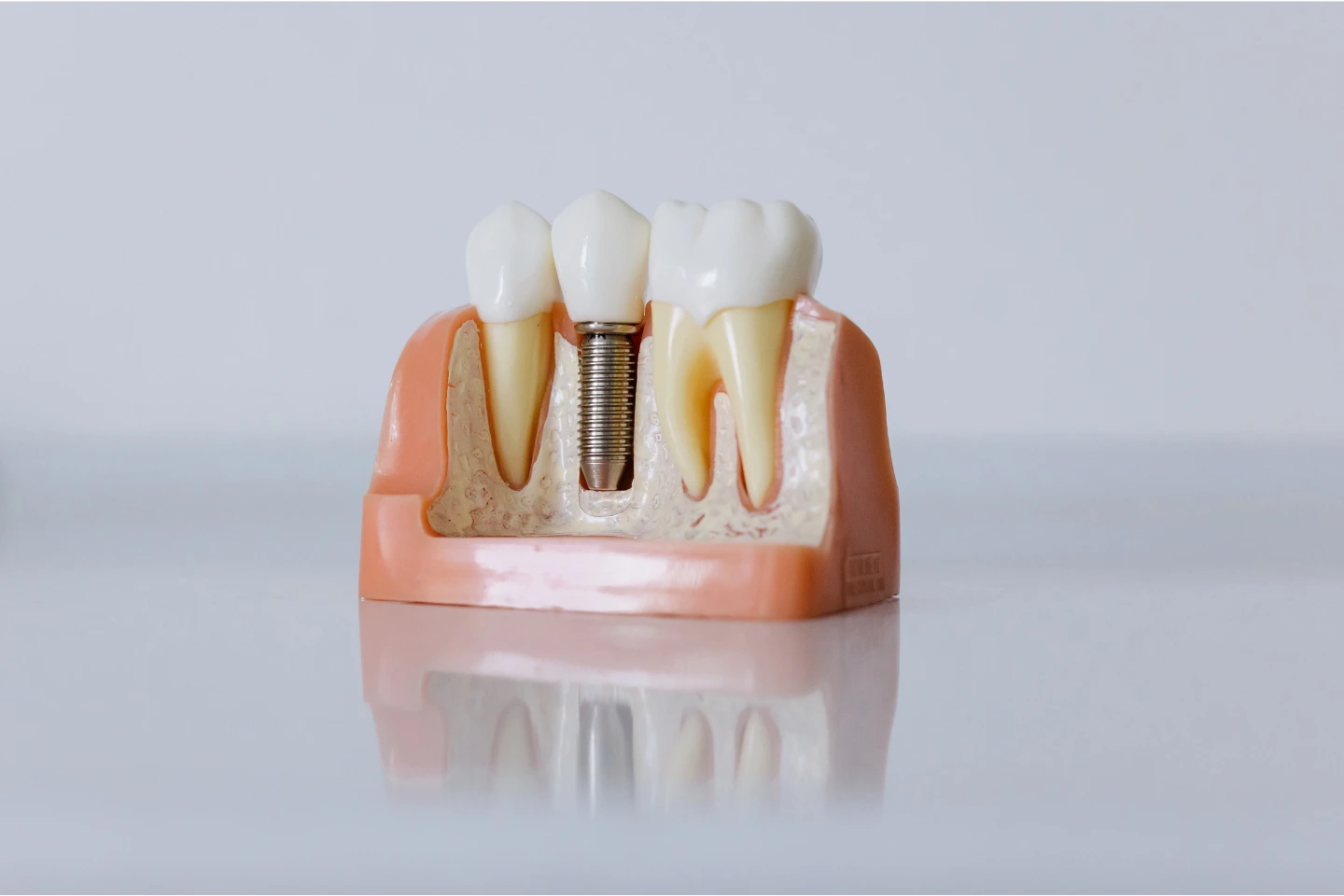 Ceramic Crowns