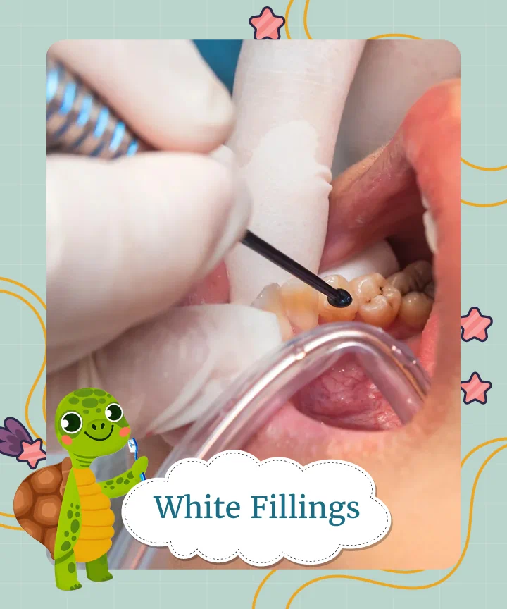 White Fillings
