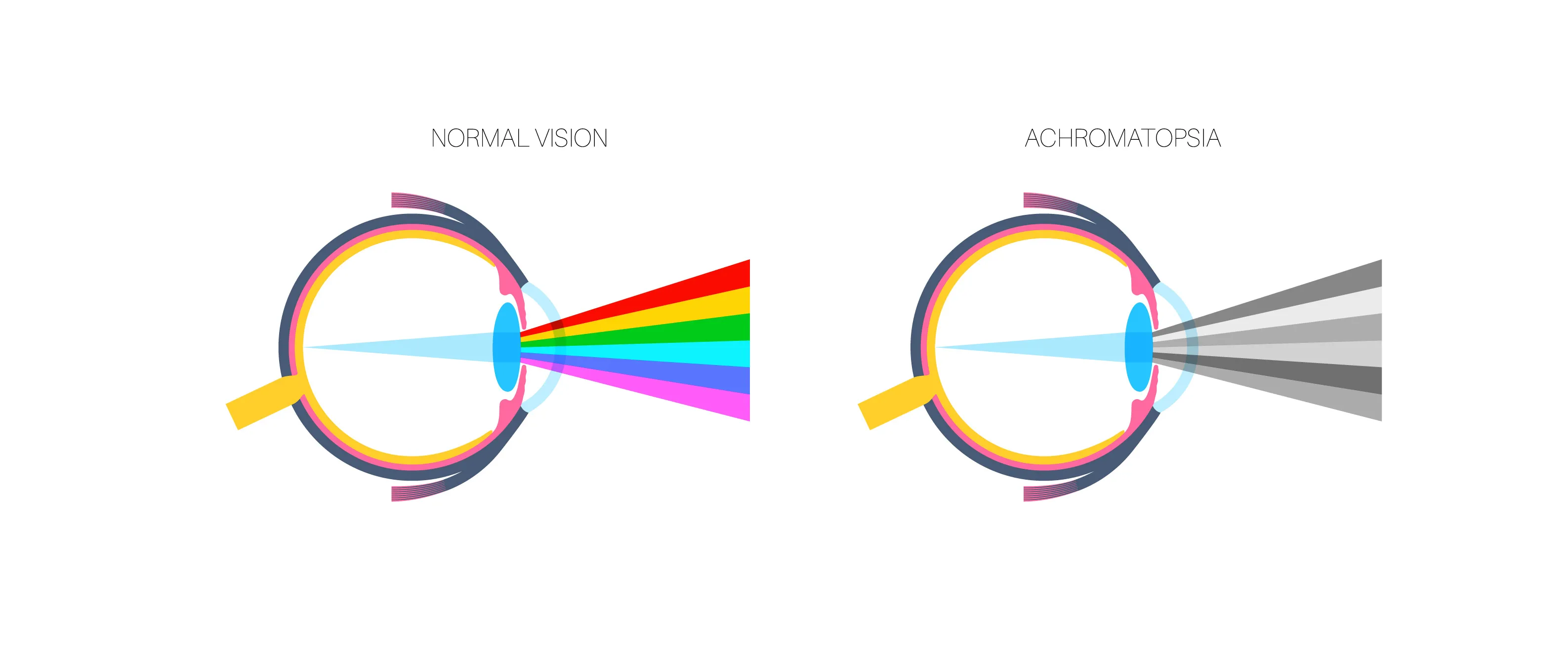 Inside a Life With Color Vision Deficiency