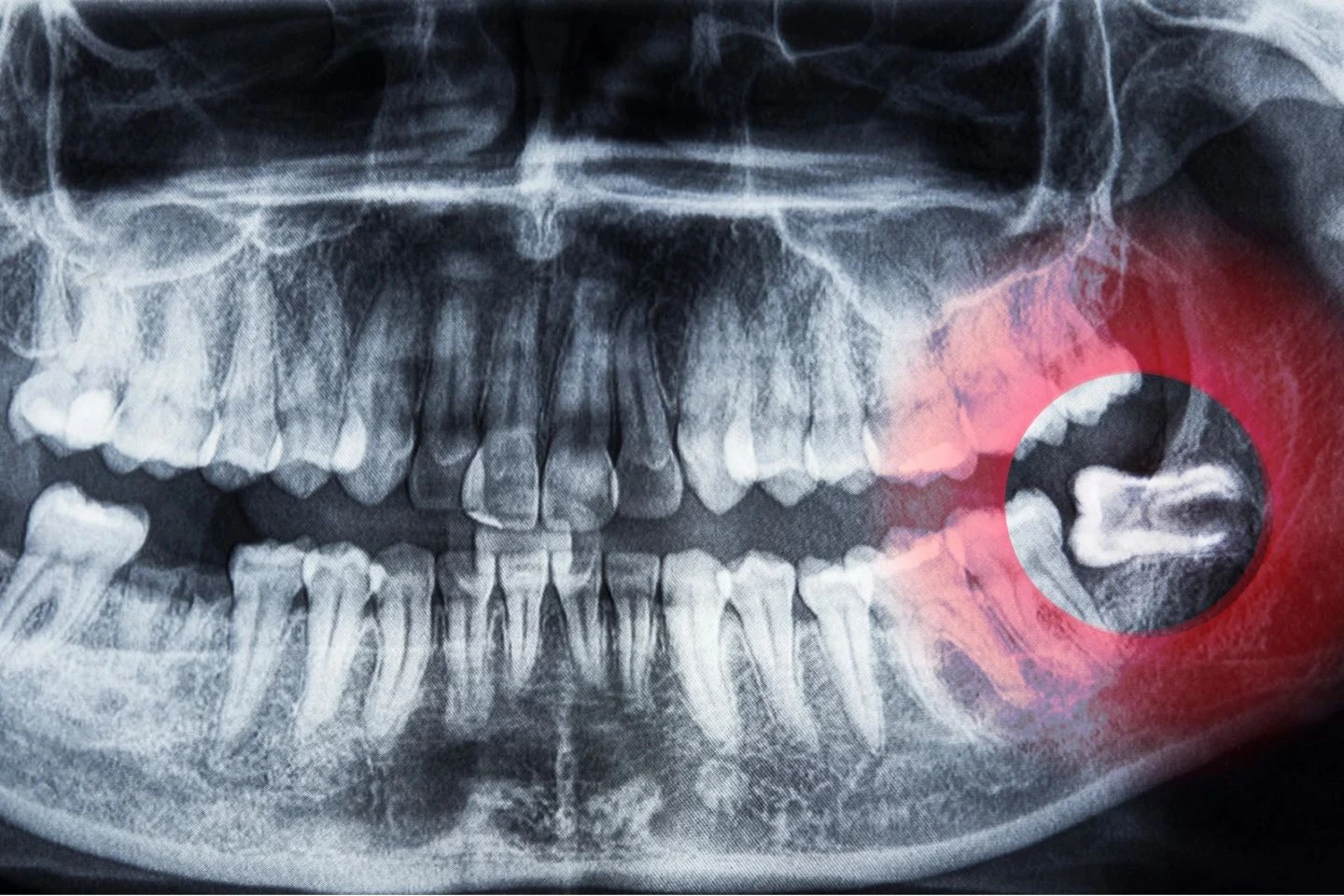 Wisdom Tooth Extraction