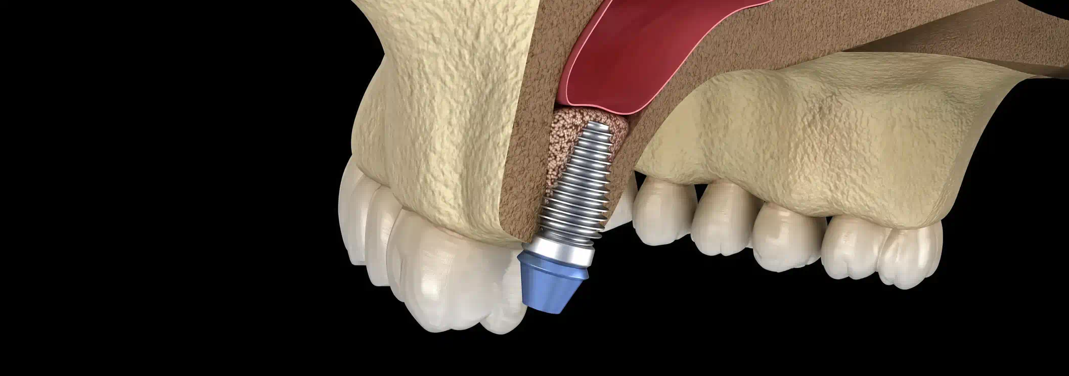Sinus Lift