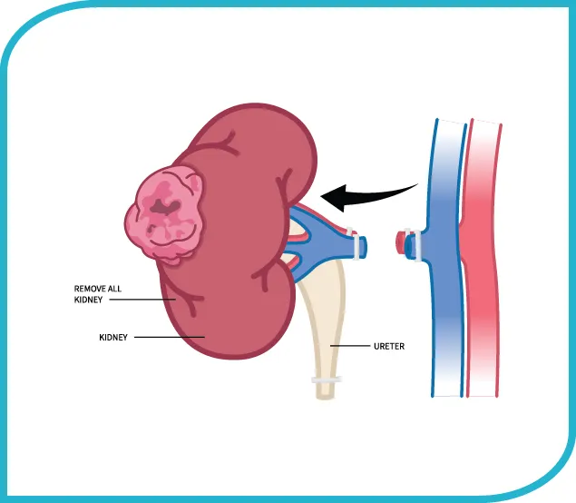 Laparoscopic Radical Nephrectomy