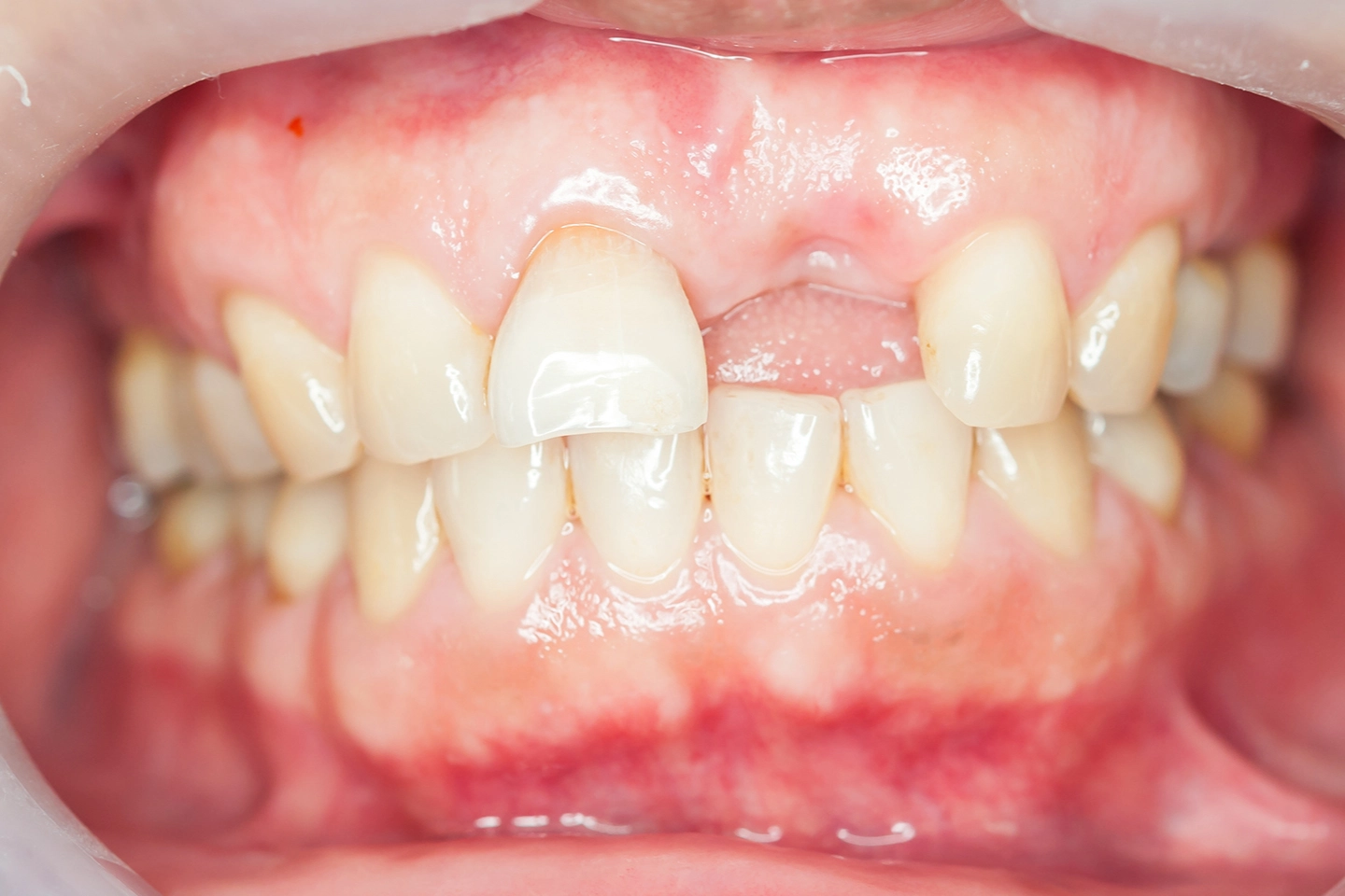 Bone Graft for Dental Implants - Rockville Family Dental