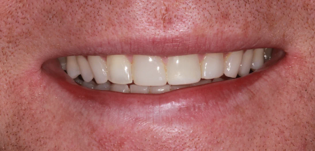 Composite Bonding