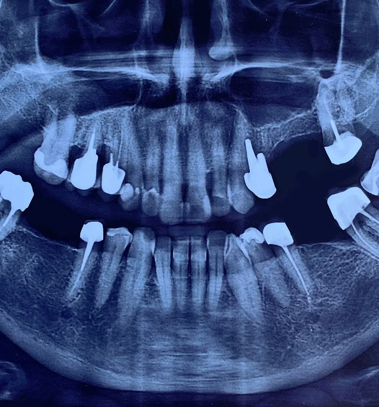 Single Tooth Implant