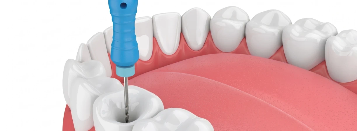 Root Canal Treatment