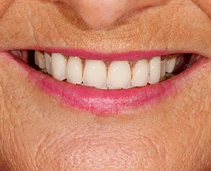 Dentures case 3