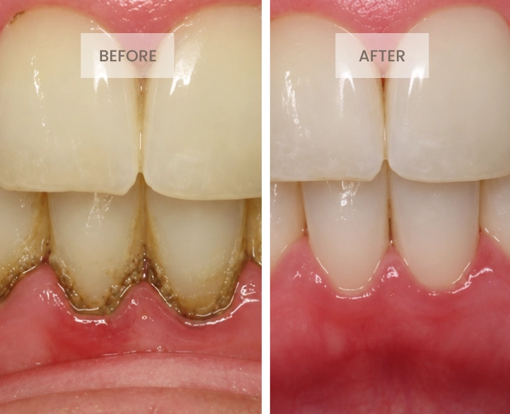 Before After 2