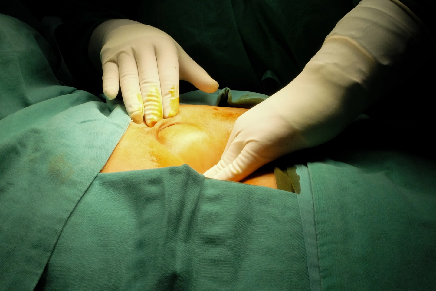 Laparoscopic Umbilical Hernia Surgery