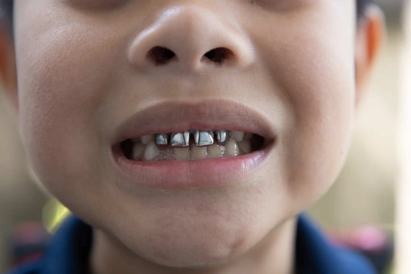 Unveiling the Aesthetics and Practicality of Metal Crowns on Front Teeth