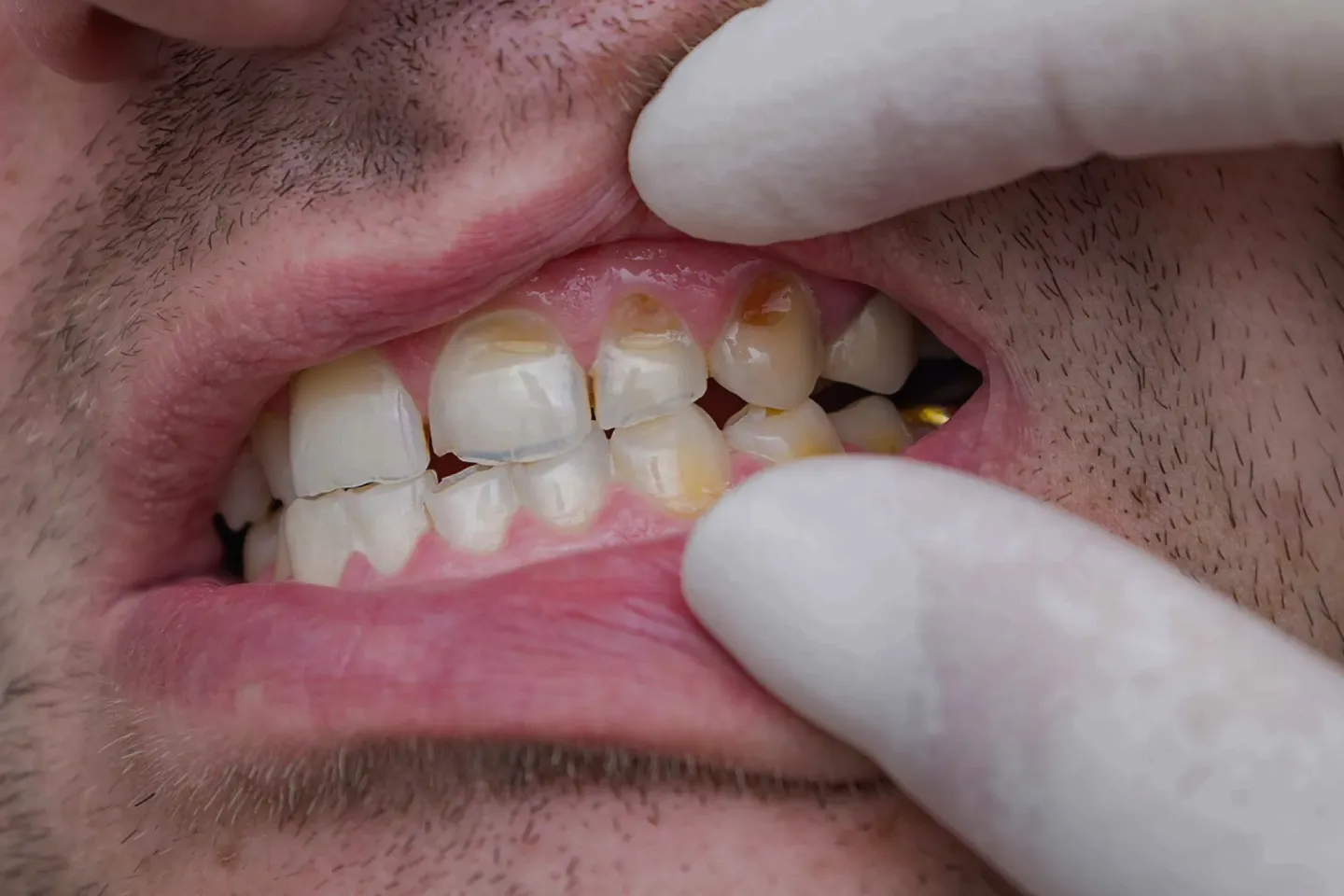 Can a Cracked Tooth Lead to a Root Canal? Warning Signs & Treatment Options