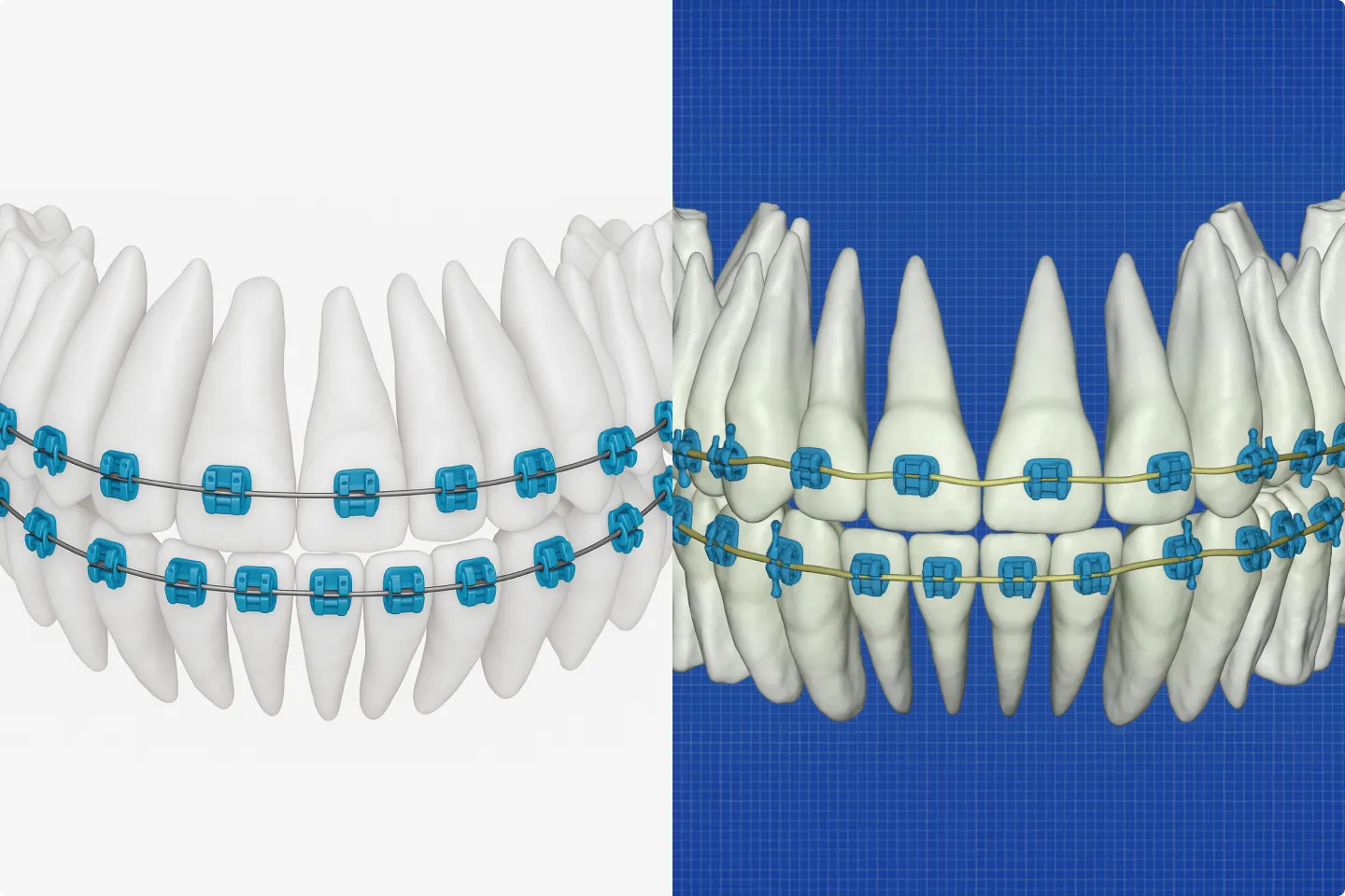 SureSmile Wire Technology