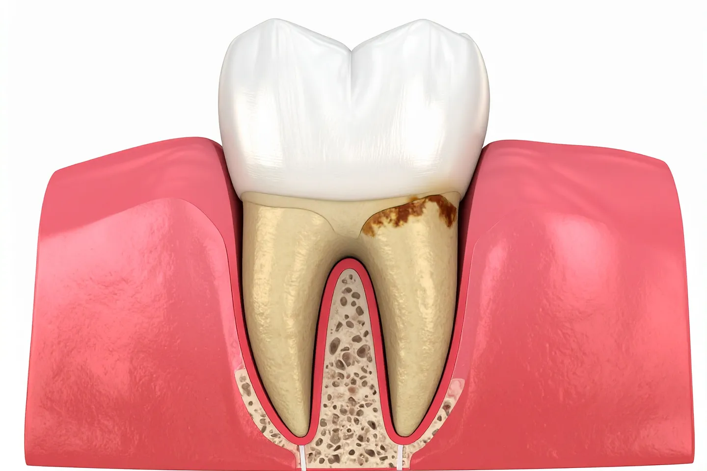 Treatment of tooth resorption