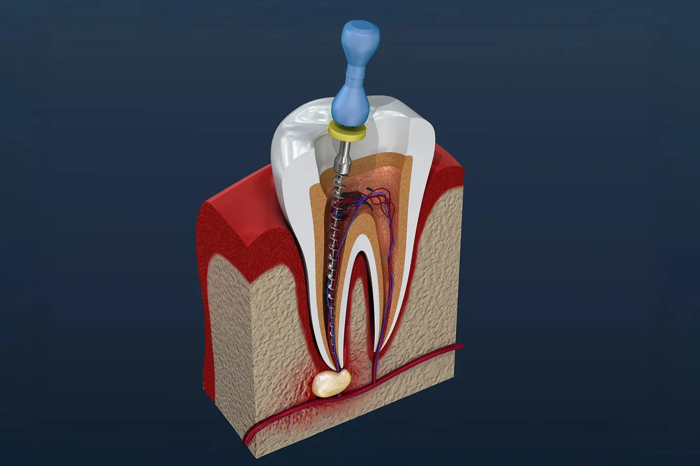 Root Canal Treatment in Santa Clara