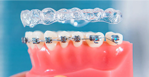 Invisalign vs Braces: Which Is Better for Working Professionals?