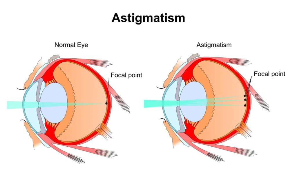 Toric Contact Lenses for Astigmatism