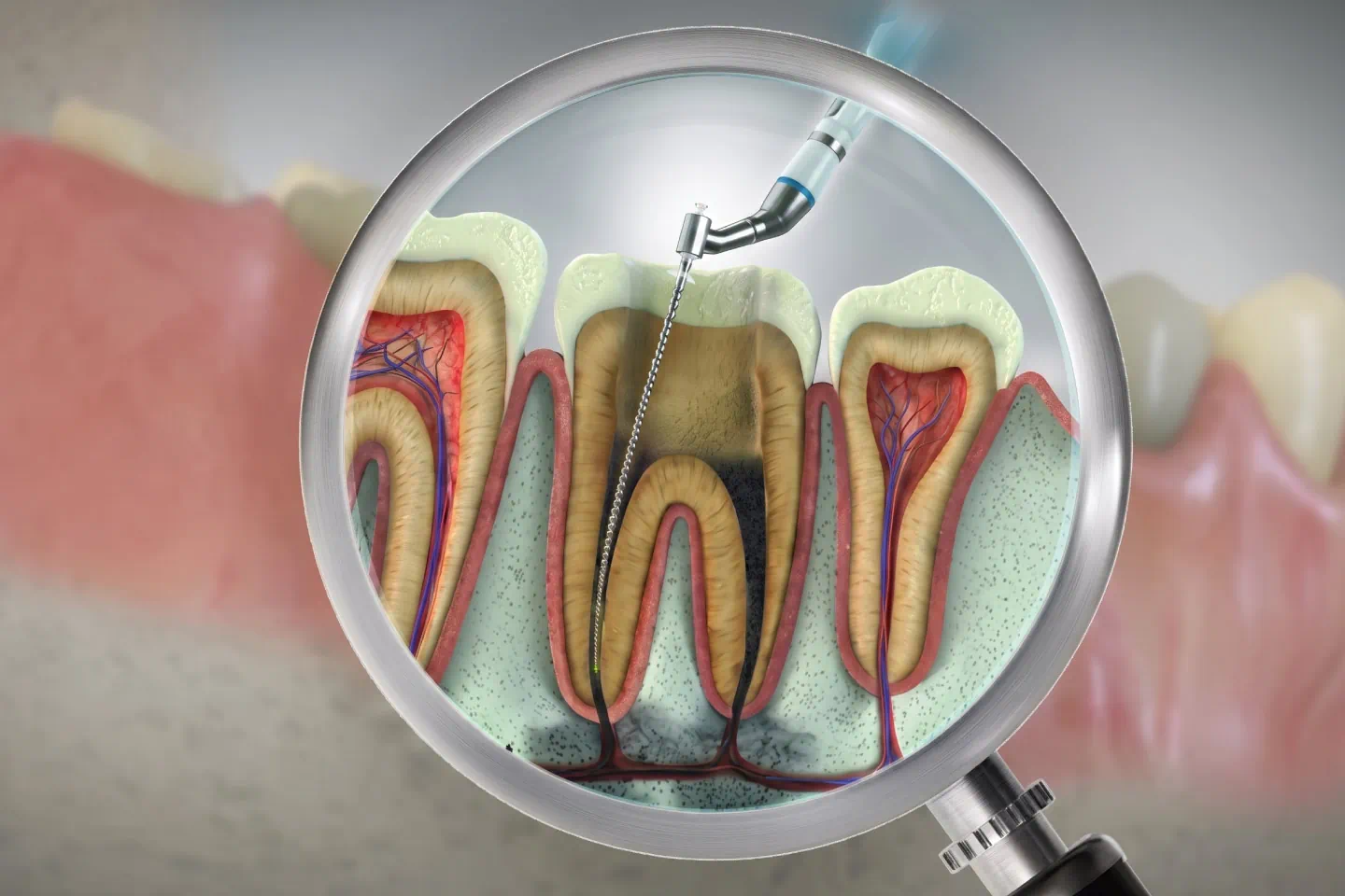 Root Canal Treatment