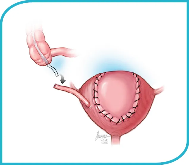 Bladder Augmentation