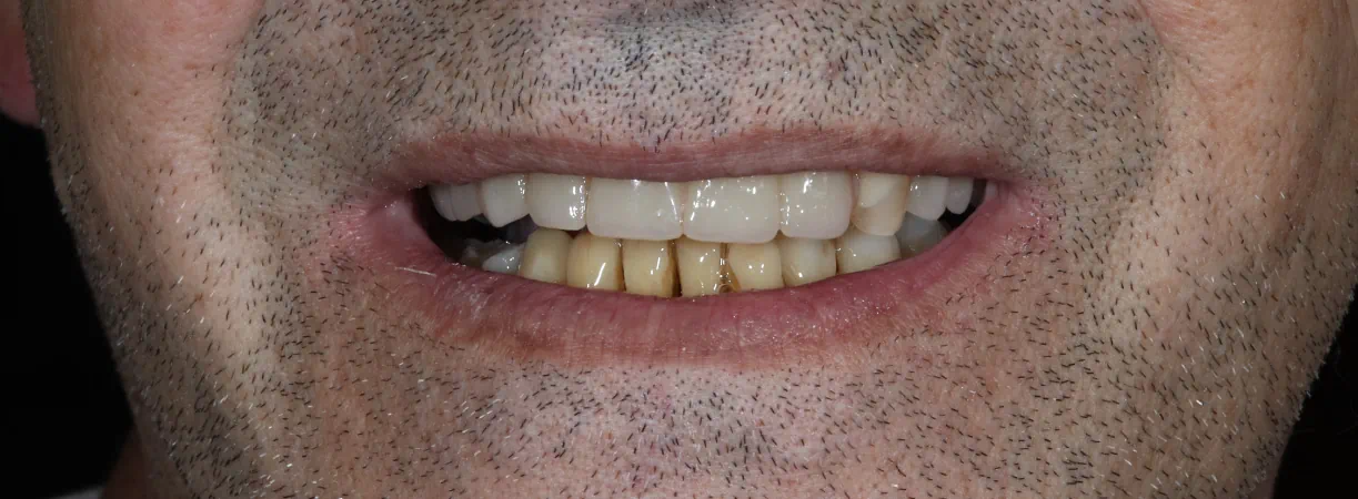 Dentures
