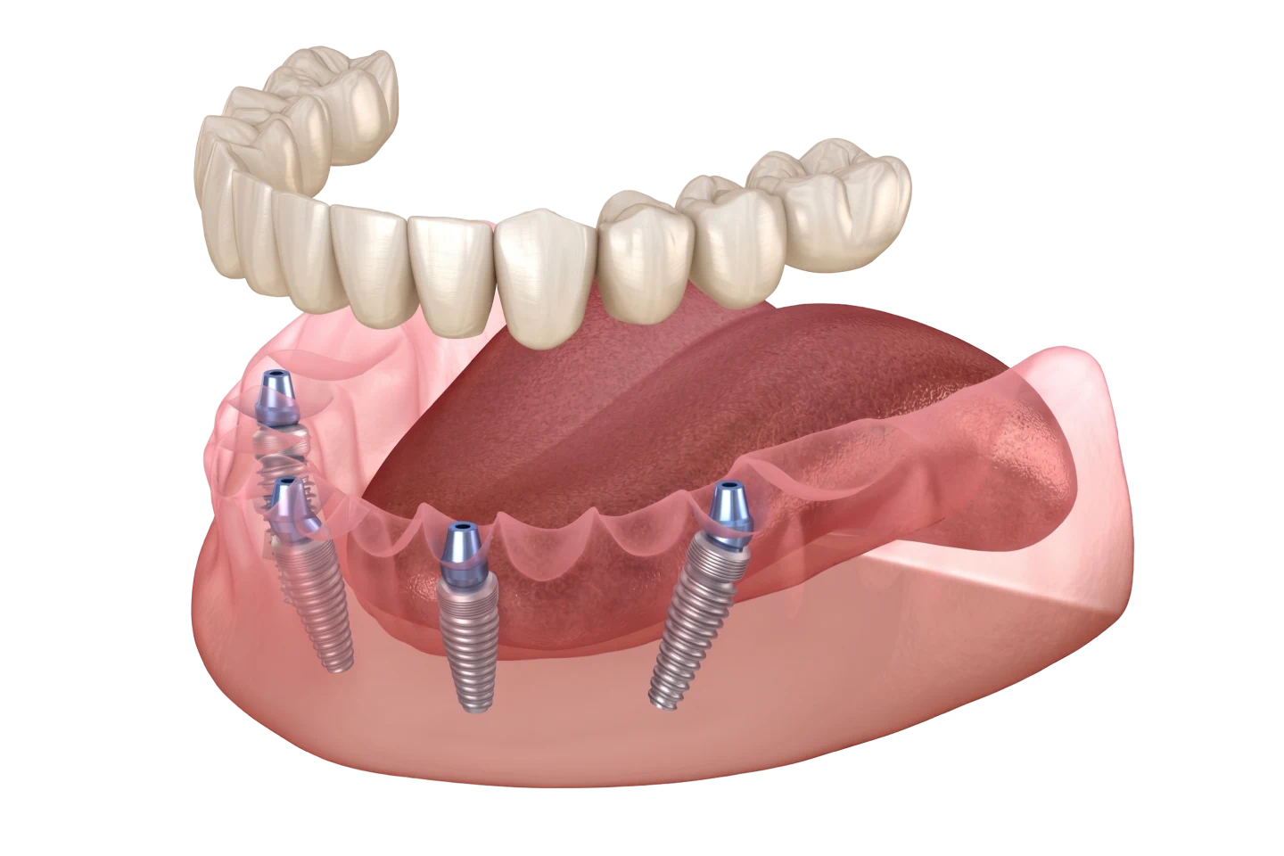 All-on-4 Dental Implant