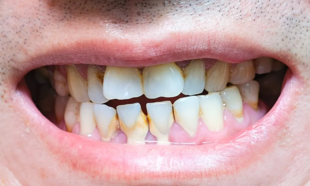 Unexpected Benefits of Gum Disease Treatment | SoFlo Dental South Miami
