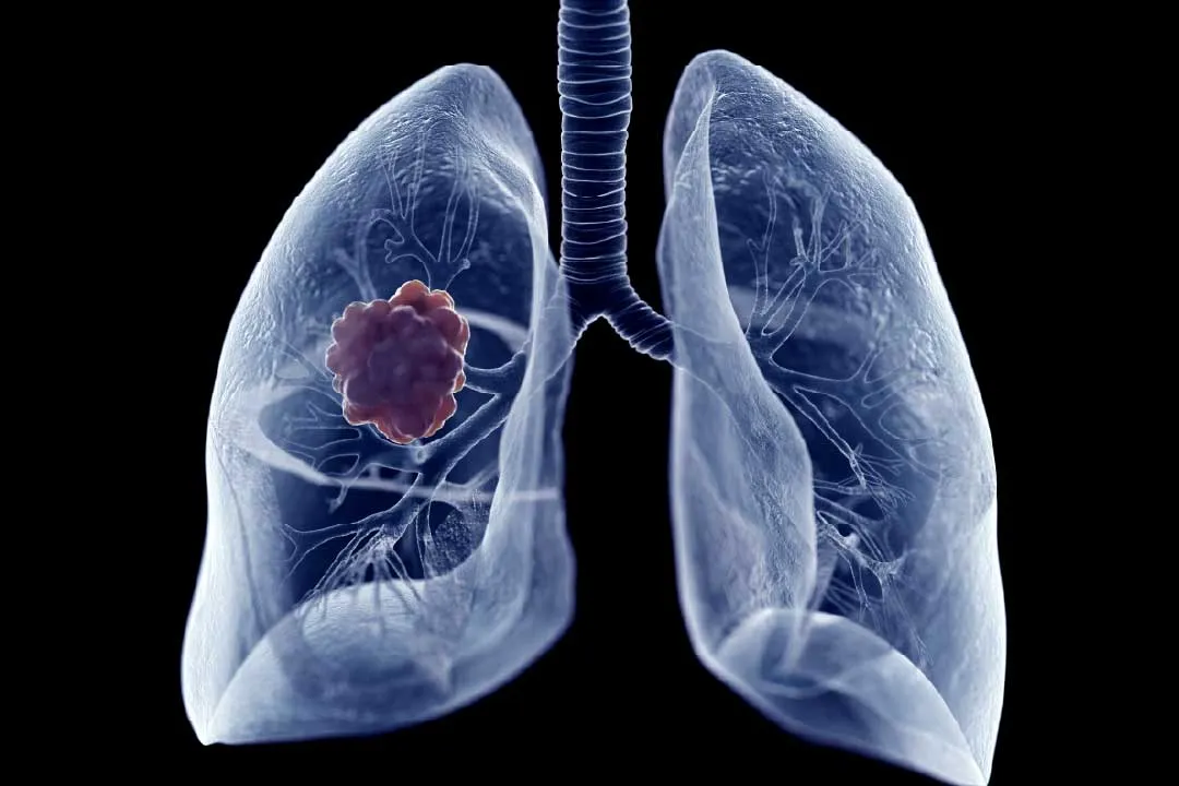 Mediastinal Tumor Excision