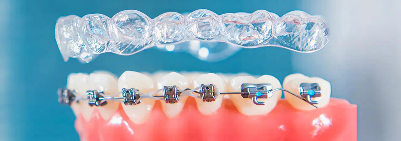 Invisalign vs Braces: Which Is Better for Working Professionals?