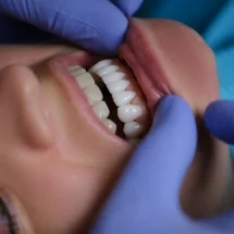 Is Composite Bonding Right for Me? A Patient’s Guide to This Popular Treatment