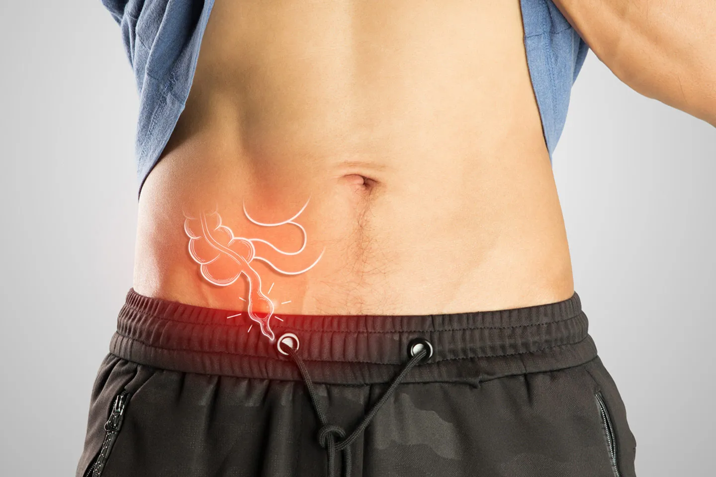 Appendix Removal
