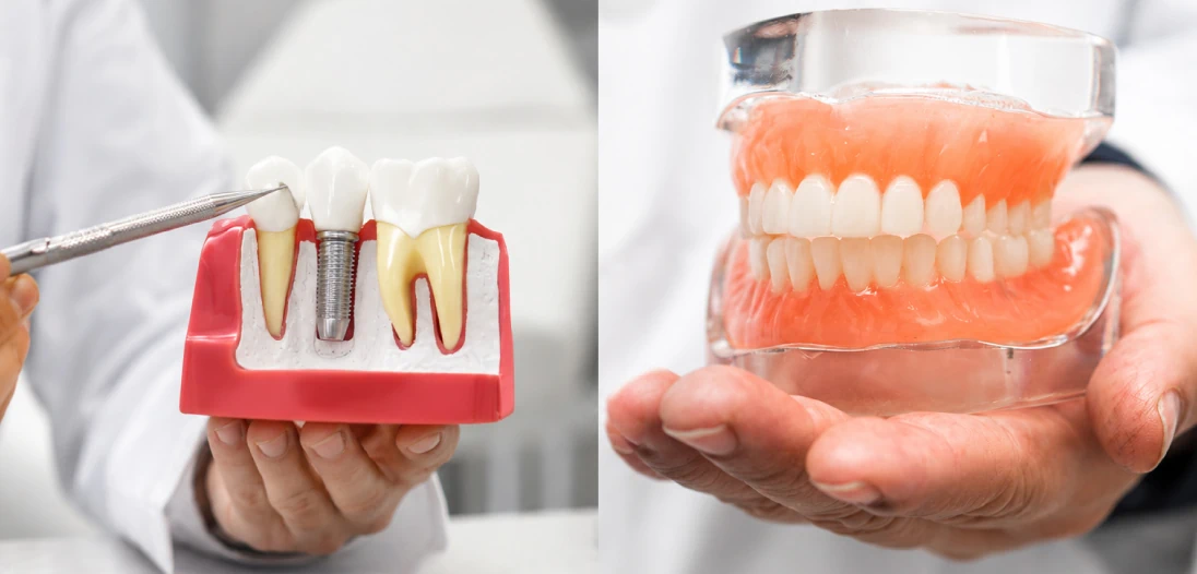 Dental Implants vs Dentures