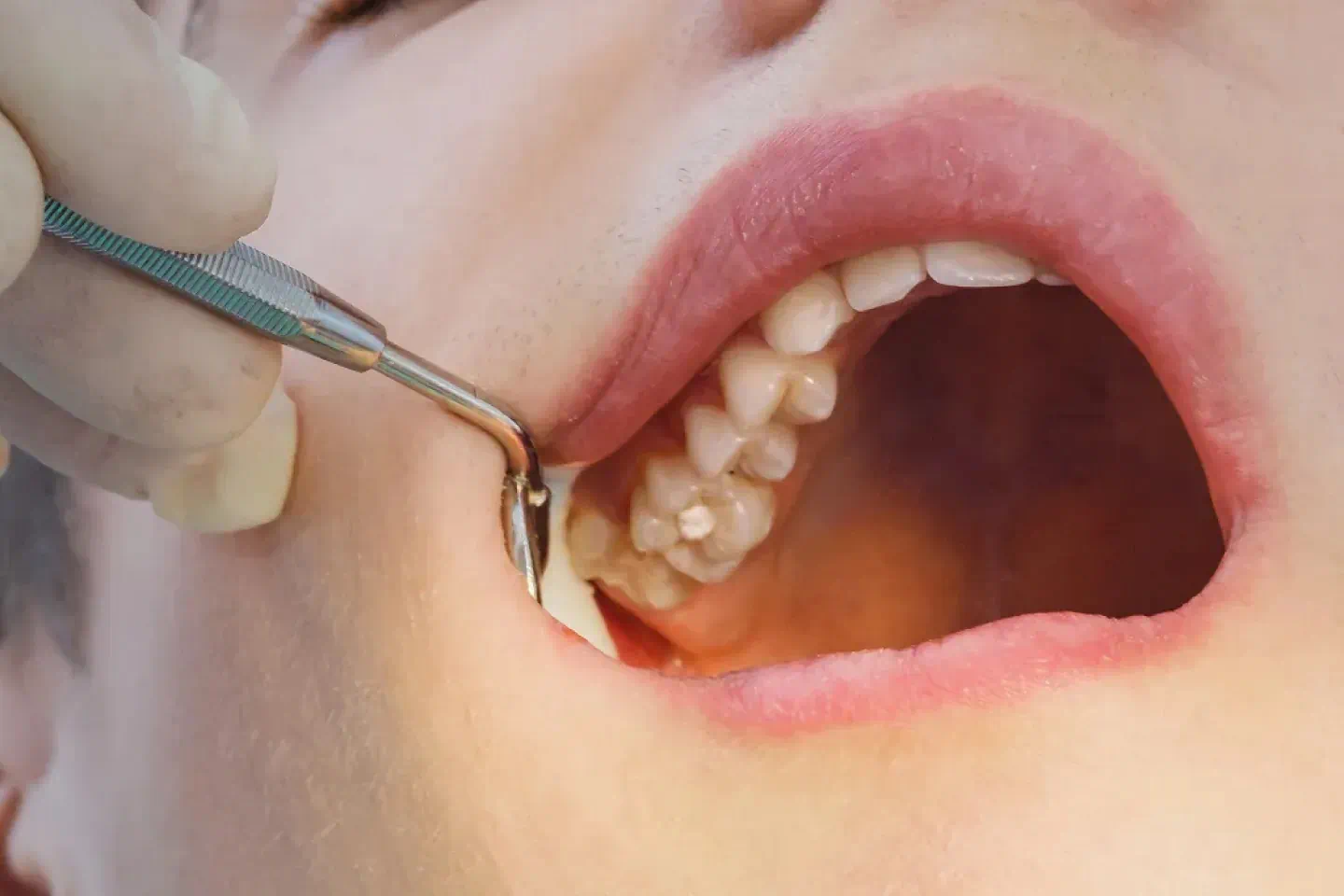 Fluoride Treatments