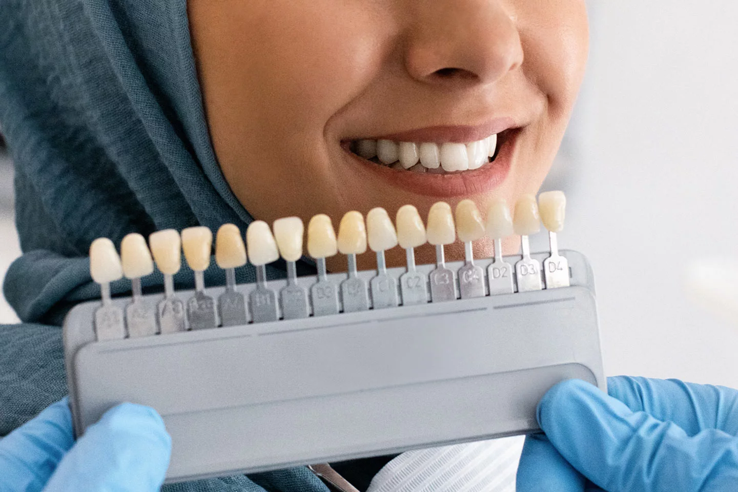 Veneers