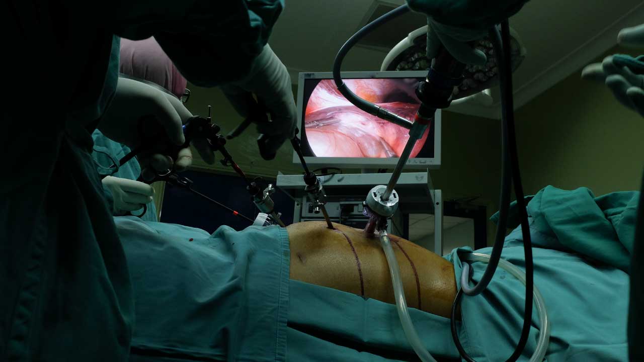 Adhesiolysis: Laparoscopic Treatment for Adhesions