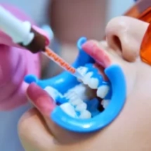 Teeth Whitening Gel – How It Should Be Used Effectively?