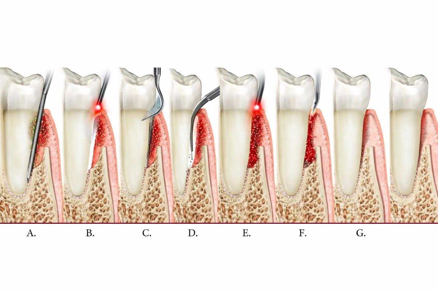 How Laser Periodontal Therapy Works: A Modern Path to Healthy Gums