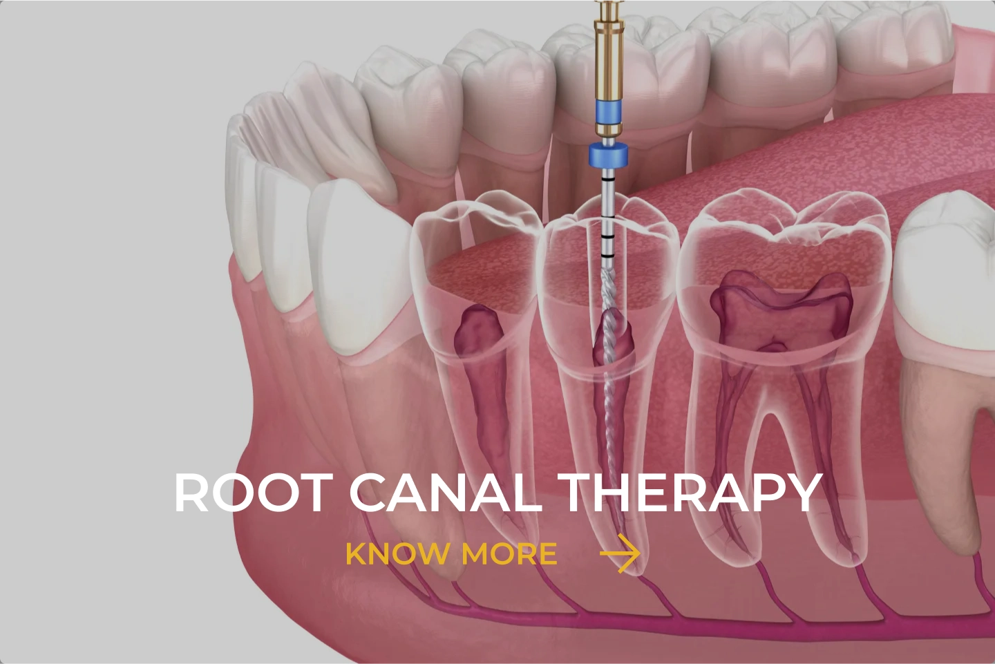 Root Canal Therapy image