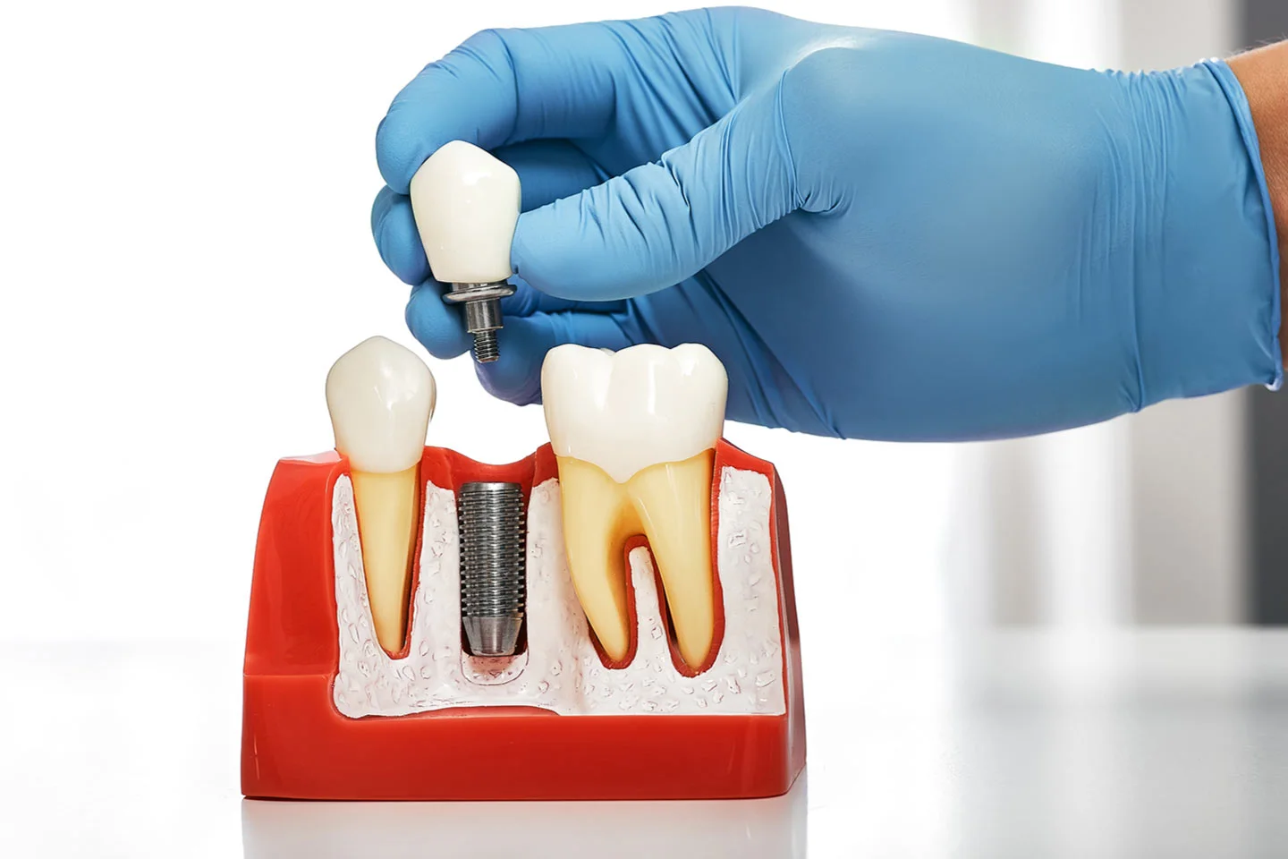 Dental Implant Placement | Dentist Mokena | Dental DeZigns