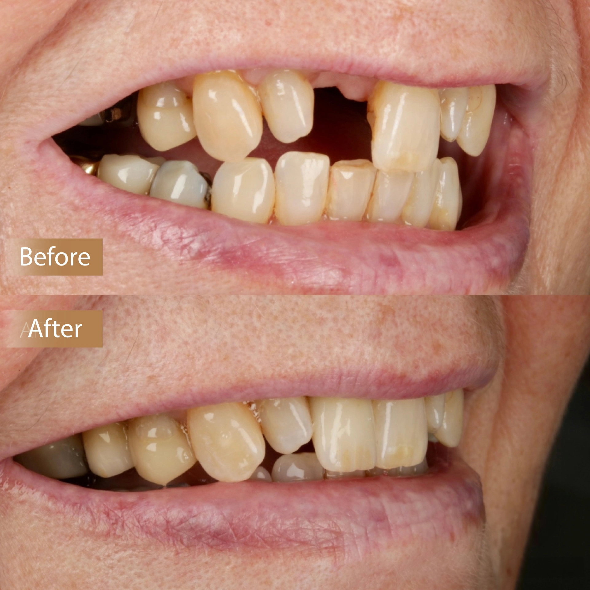 Two Dental Implants