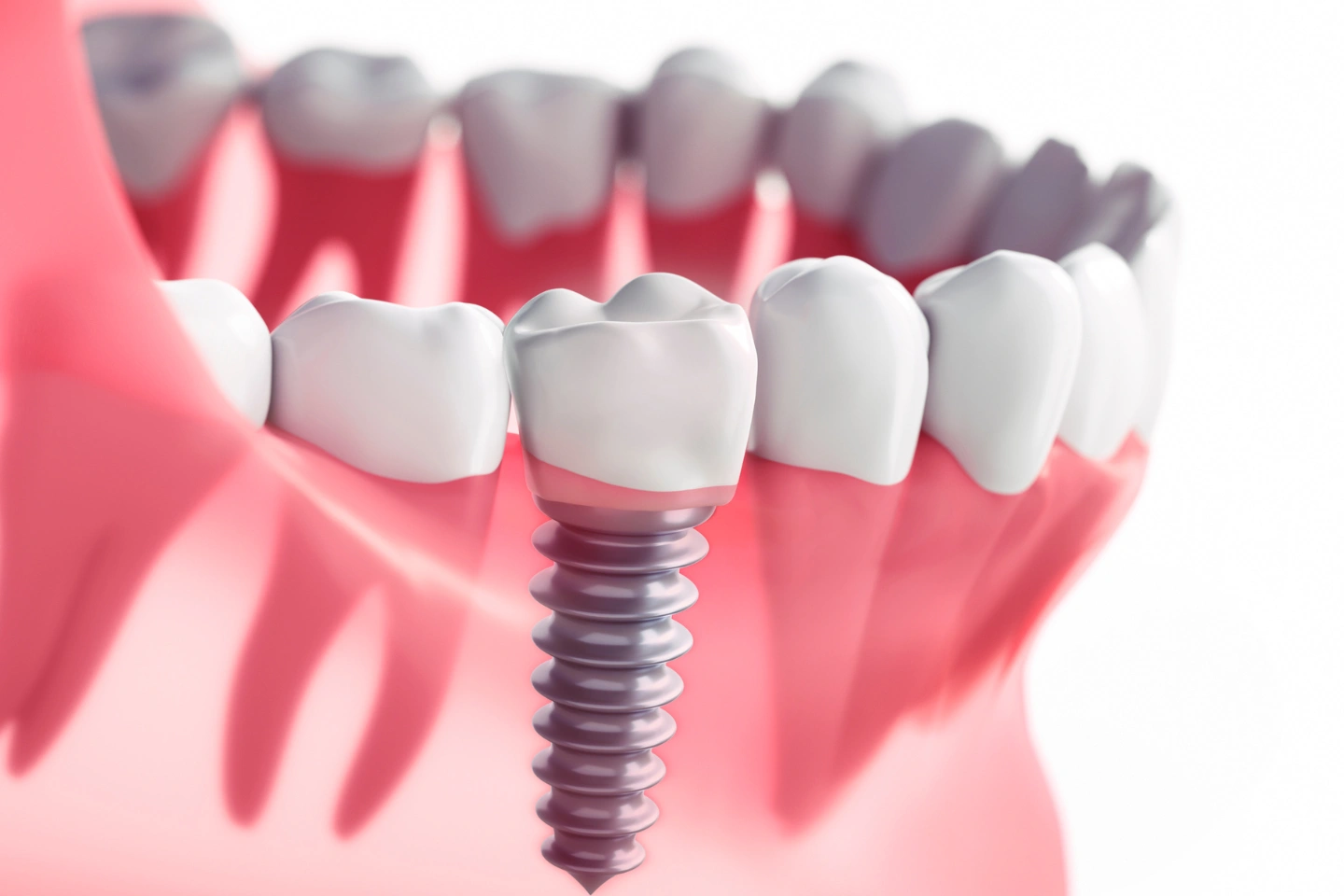 Dental implants Lincolnia, VA