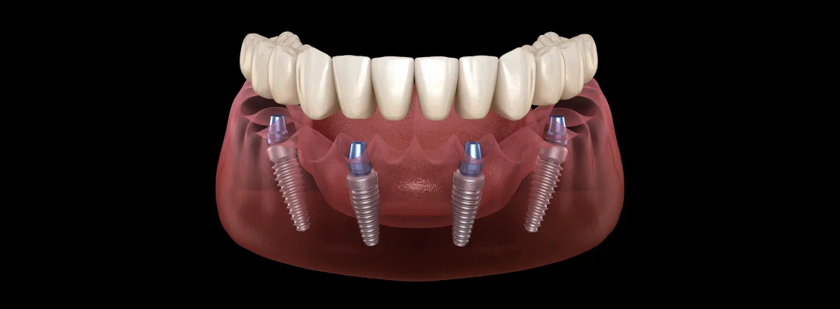 All-on-X Implants