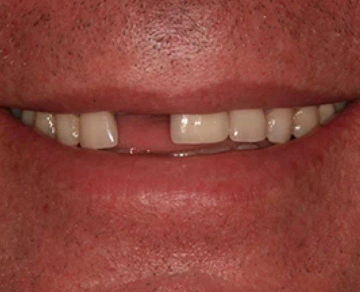 Implant Care 2