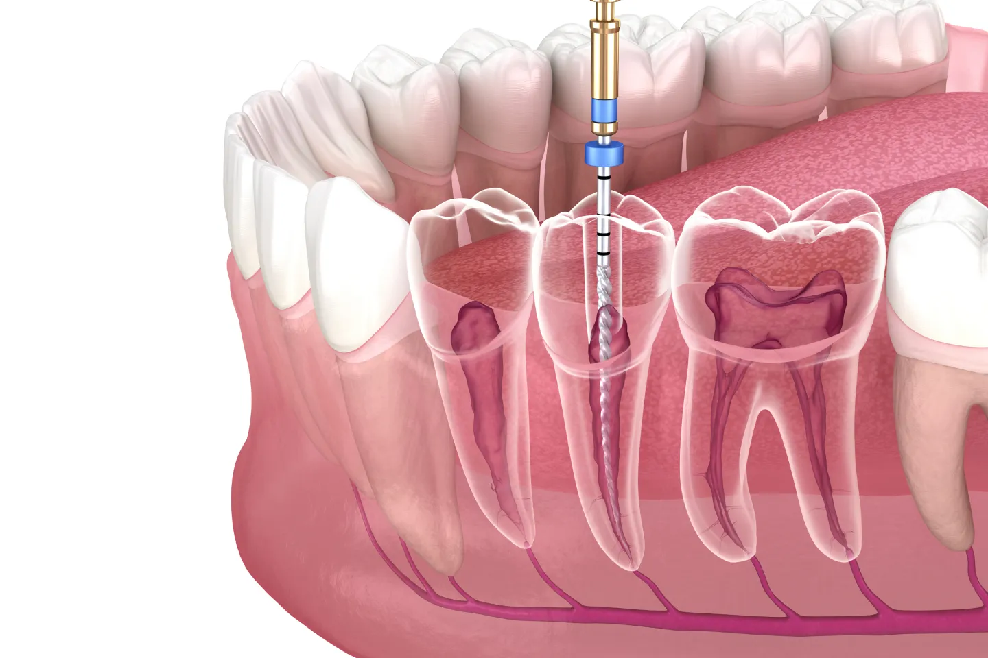 Root Canal Treatment