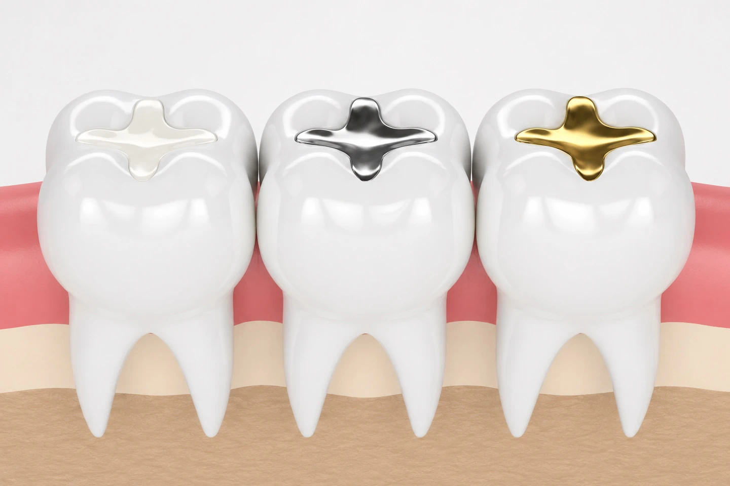 Dental Filling