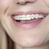 Crooked Teeth – How to Fix it With Braces?