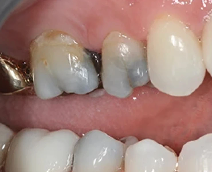 cerec