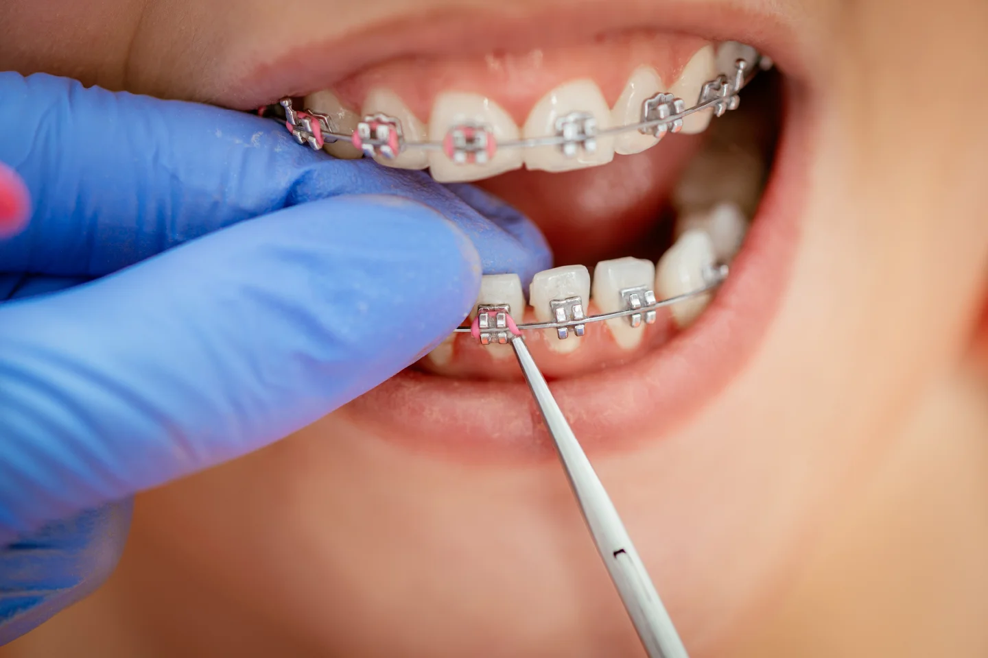 Care During Orthodontic Treatment