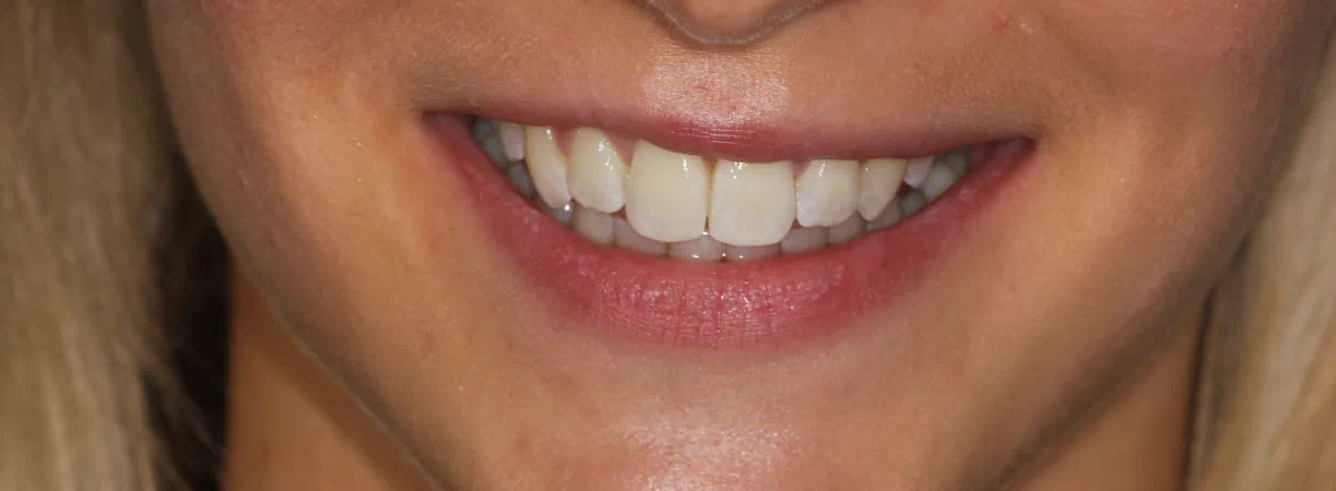 6 Month Smiles